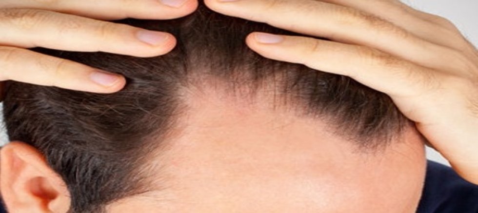 Saç dökülmesine yol açan 9 önemli etken 