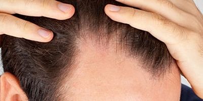 Saç dökülmesine yol açan 9 önemli etken 